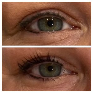 Refine Treatment Gallery1