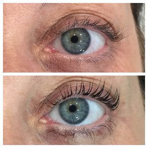 Refine Treatment Gallery2